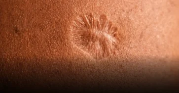 Cicatrice du vaccin contre la variole pourquoi cela se produit il.jpg