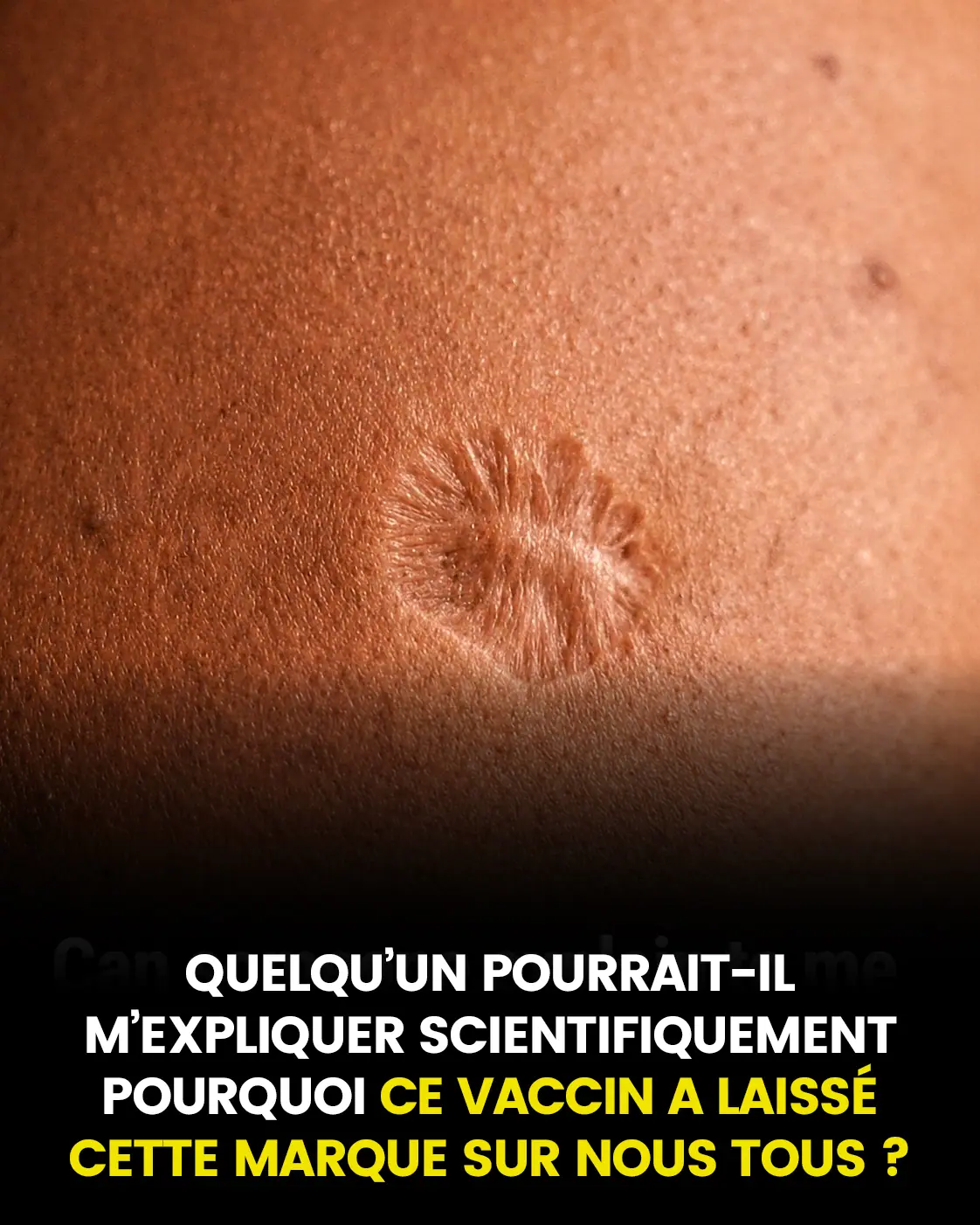 Cicatrice du vaccin contre la variole pourquoi cela se produit il.jpg